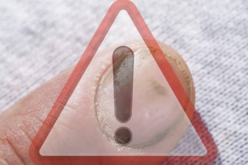 Nonostante la sua diffusione, che interessa circa 300mila persone in Italia, l’artrite psoriasica rimane una sfida clinica significativa